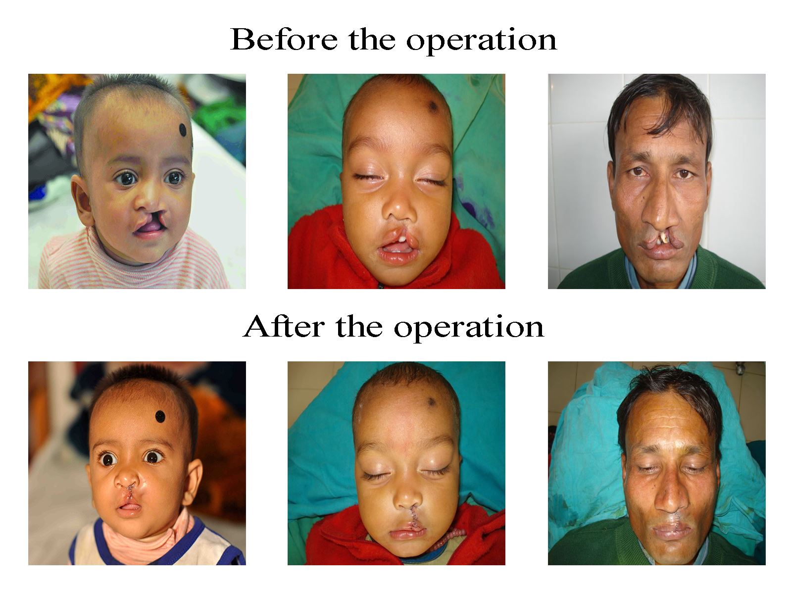 Smile Train RCH Cleft Project (STRCP)