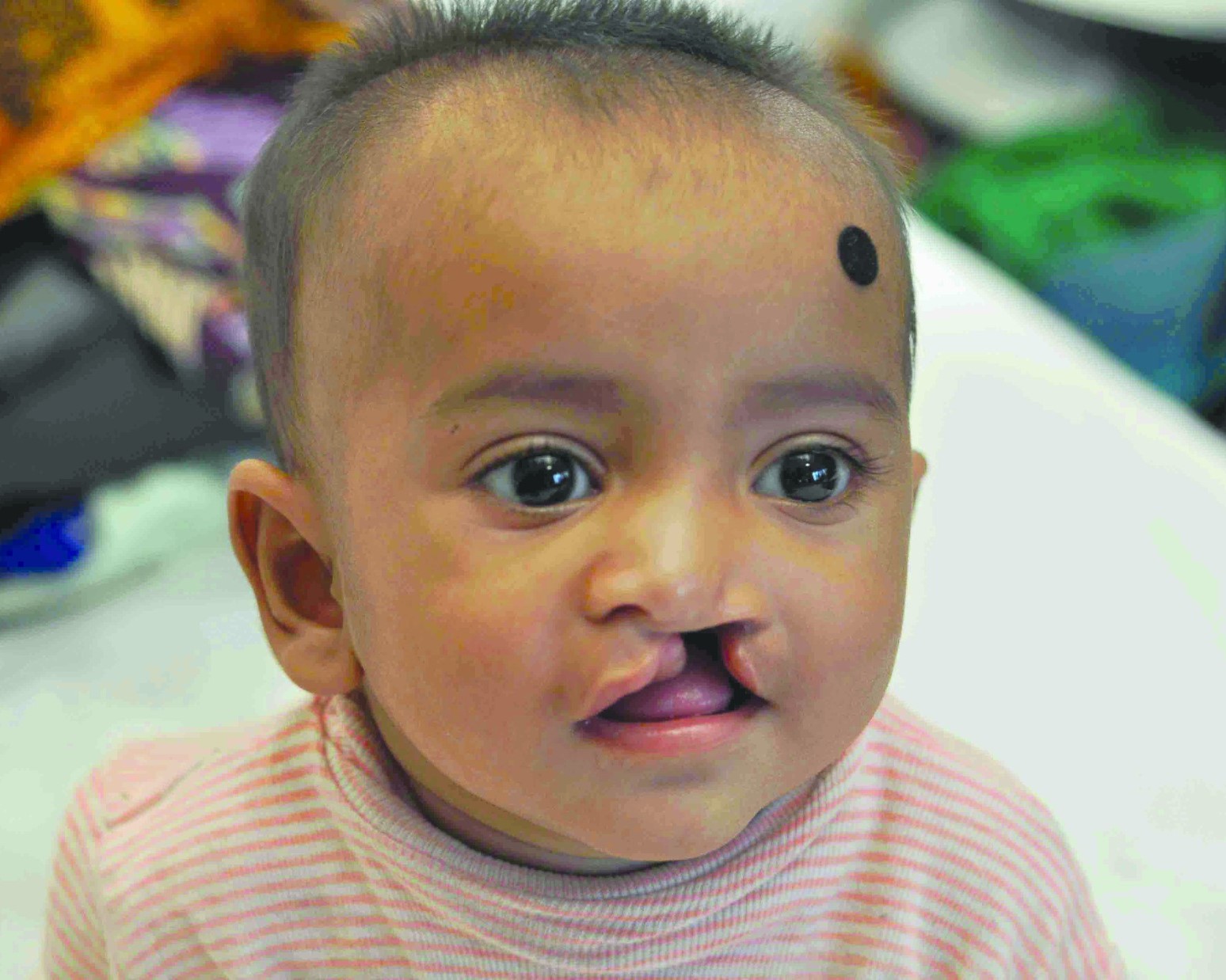 Smile Train RCH Cleft Project (STRCP)
