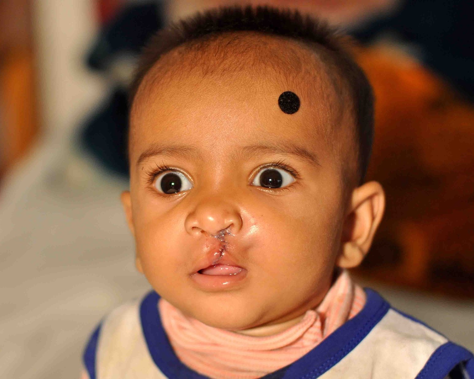 Smile Train RCH Cleft Project (STRCP)