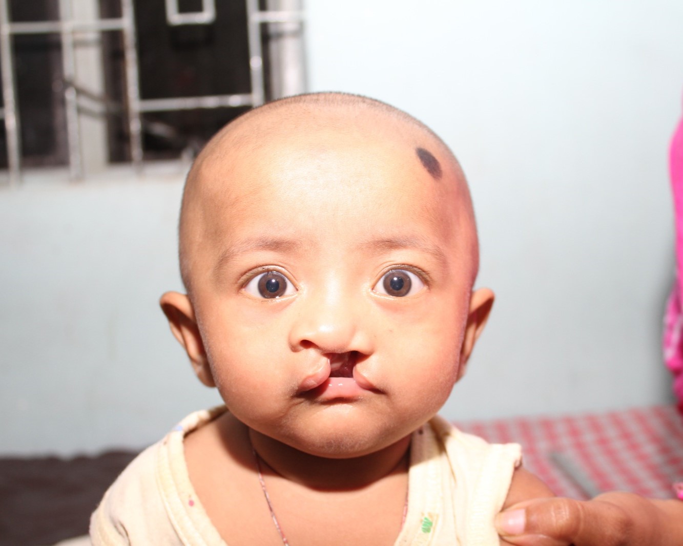 Smile Train RCH Cleft Project (STRCP)